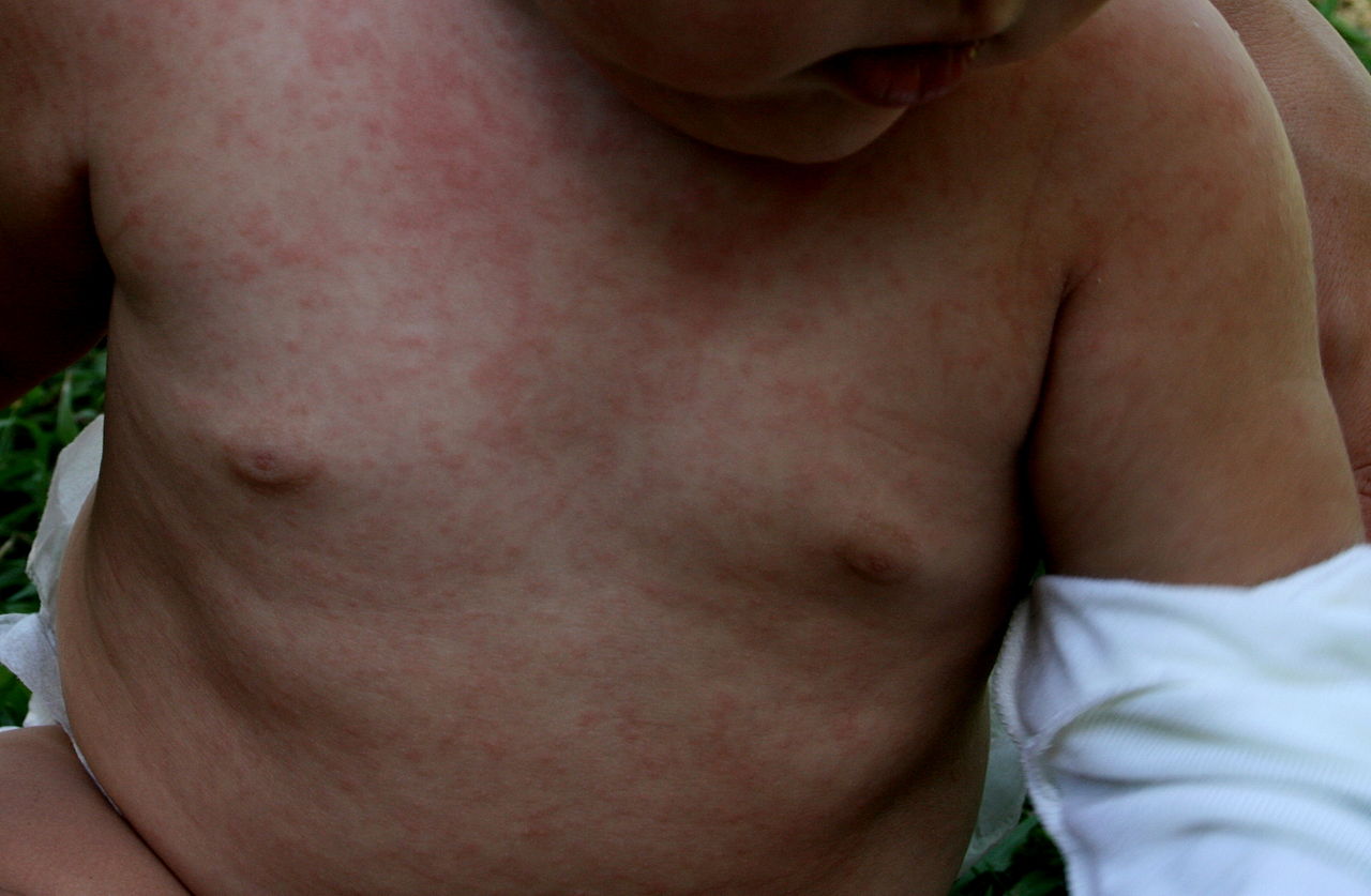 Exanthem subitum (meaning sudden rash), also referred to as roseola infantum (or rose rash of infants), sixth disease (as the sixth rash-causing childhood disease) and (confusingly) baby measles, or three day fever, is a benign disease of children, generally under two years old, whose manifestations are usually limited to a transient rash ("exanthem") that occurs following a fever of about three day's duration