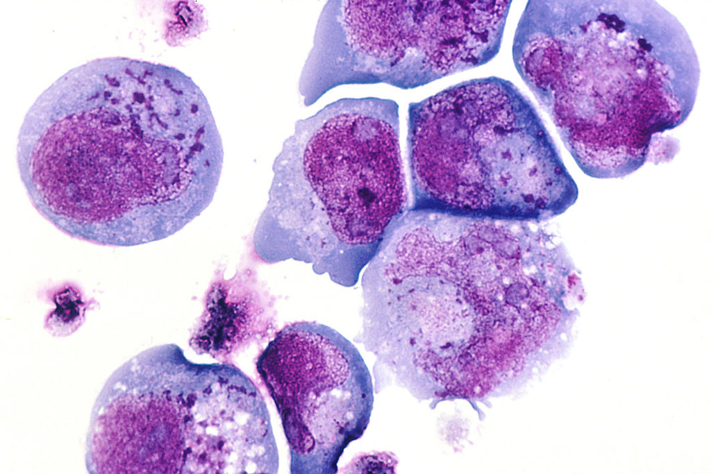 This is a histological slide of the human herpes virus-6 (HHV-6) previously known as HBLV, a type of herpes virus that was discovered in October, 1986