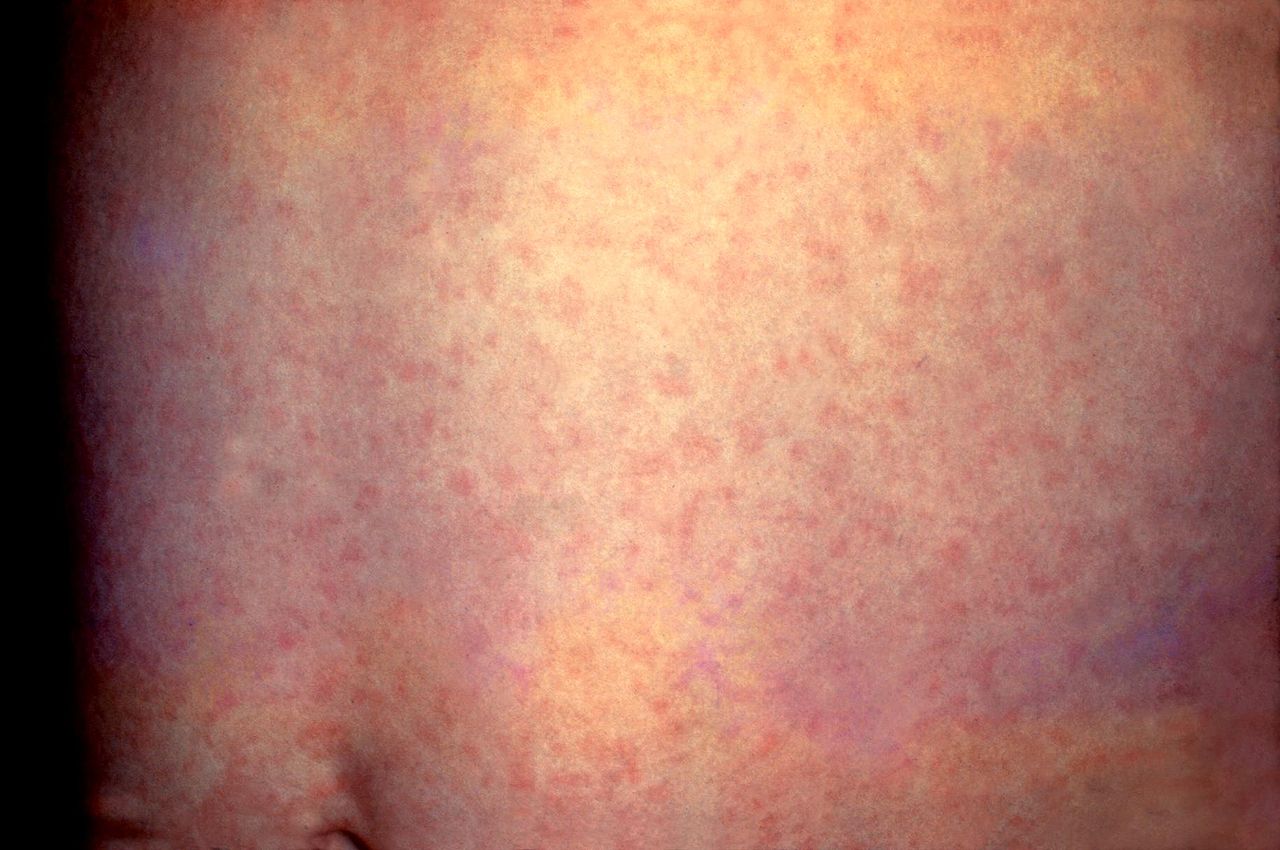 This patient presented with a generalized rash on the abdomen caused by German measles (rubella)