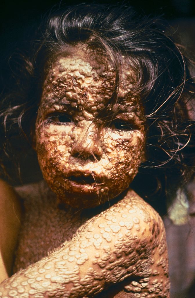 This young girl in Bangladesh was infected with smallpox in 1973, Freedom from smallpox was declared in Bangladesh in Decembe