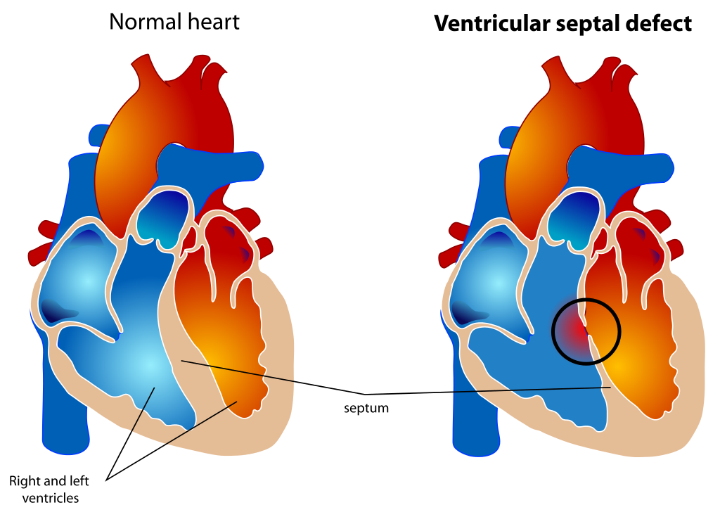 <p>The diagram shows a healthy heart on the left and a heart with the 4 anatomic malformations characteristic of the Tetralogy of Fallot on the right