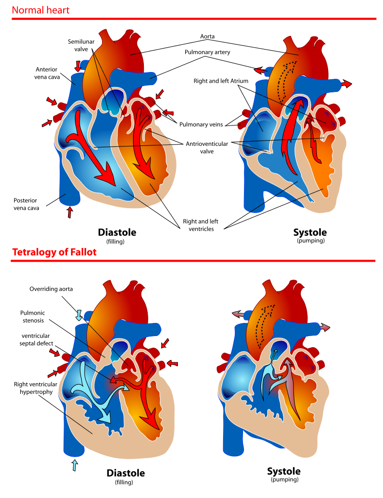 The diagram shows a healthy heart during pumping and filling
