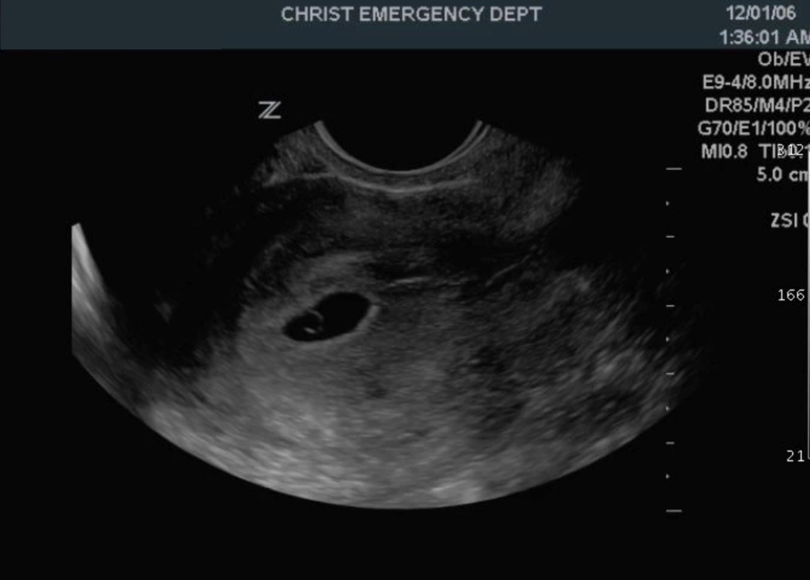 <p>A Retroverted Uterus With Gestational Sac