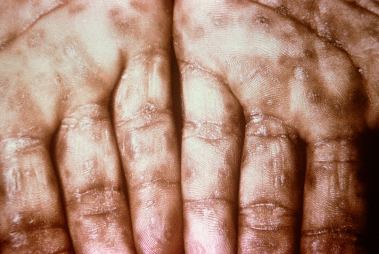 <p>Keratotic Lesions on the Palms