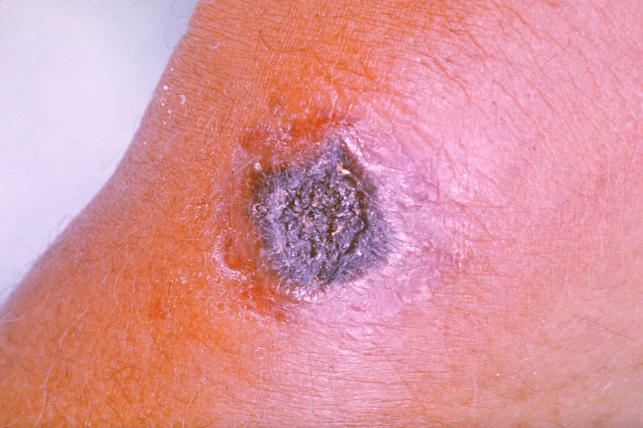 A skin lesion caused by anthrax.
