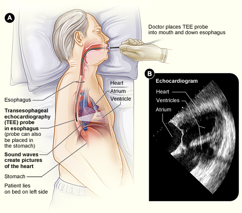 Figure A shows a transesophageal echocardiography probe in the esophagus, behind the heart