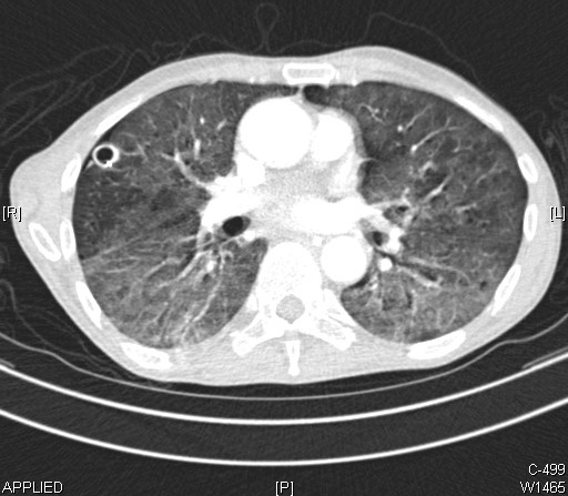 <p>Computed Tomography of a Lung Abscess