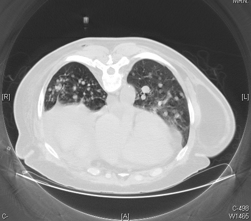<p>Metastatic Follicular Thyroid Carcinoma, CT Scan</p>