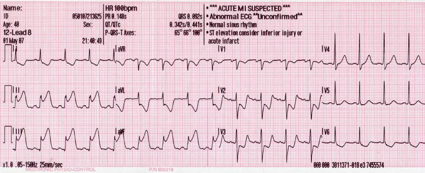 <p>ECG With&nbsp;Pardee Waves Indicating AMI