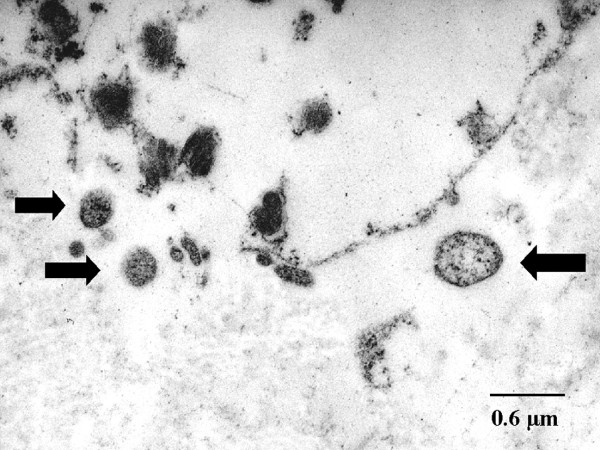 Transmission electron microscopy of alpha-1 antitrypsin deficiency emphysema, Chlamydial bodies shown by arrows, destruction 