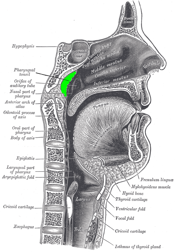 Sagittal Section of Nose, mouth, Pharynx, Larynx, Adenoid Hypertrophy, Pathology, Obstruction of the nasal airways