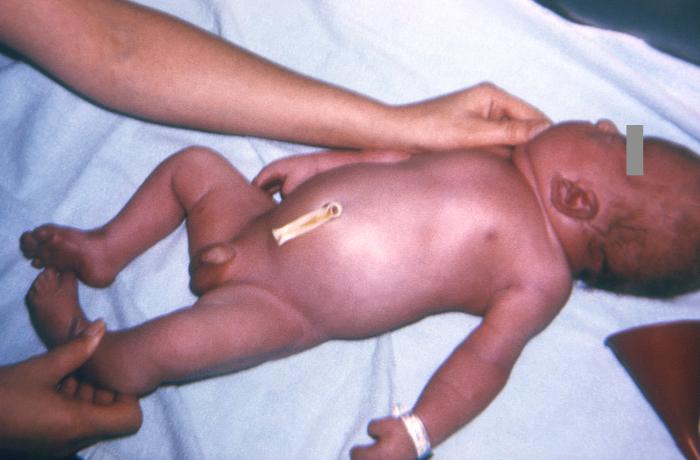 <p>Syndactyly,&nbsp;a&nbsp;Common Congenital Anomaly&nbsp;of the Extremities