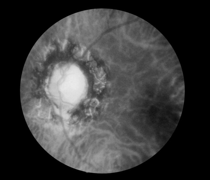<p>Fundoscopic Image of Late Neuroocular Syphilis
