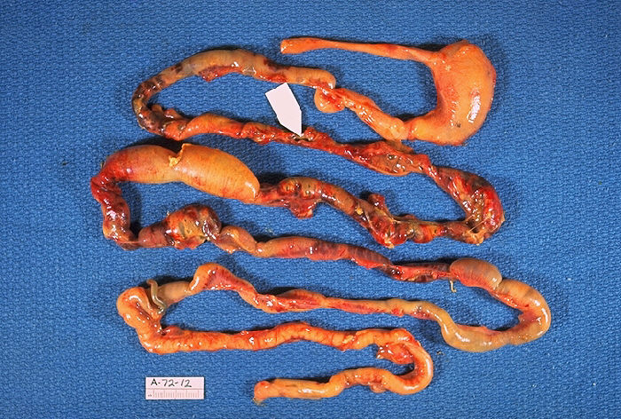 Gross Pathology, Neonatal, Necrotizing enterocolitis, Alimentary tract of infant, intestinal necrosis, pneumatosis intestinal