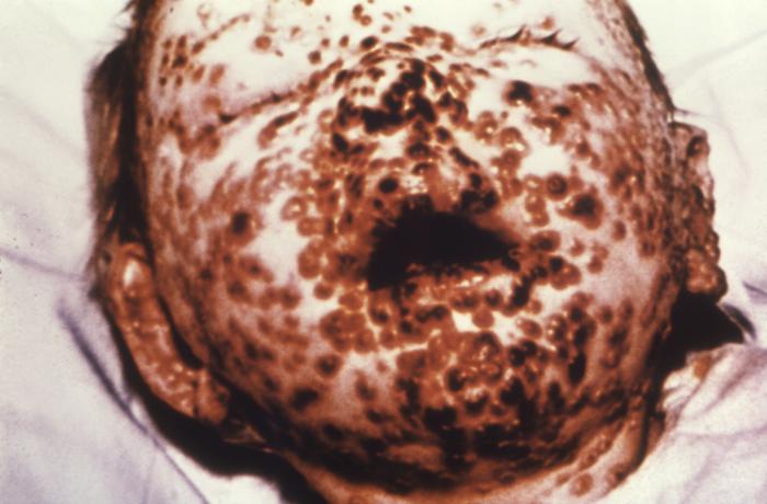 Face of a one year-old infant, Child, Smallpox virus, Dermatological manifestation, benign semi-confluent variola, 10th day p