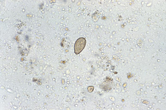 Pathology, Trematode, Parasite, Clonorchis Sinensis eggs, Infection