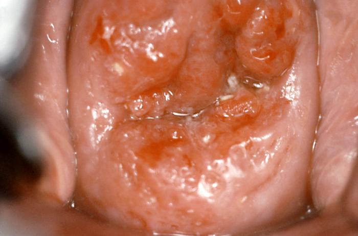 <p>Invasive Cervical Cancer. Colposcopic view of the cervix in a patient with invasive cervical cancer.</p>