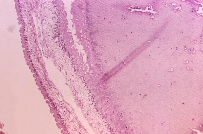 Photomicrograph, Brain tissue specimen revealed the presence of cysticerci, Cysticercosis, Eggs of a pork tapeworm, Taenia so