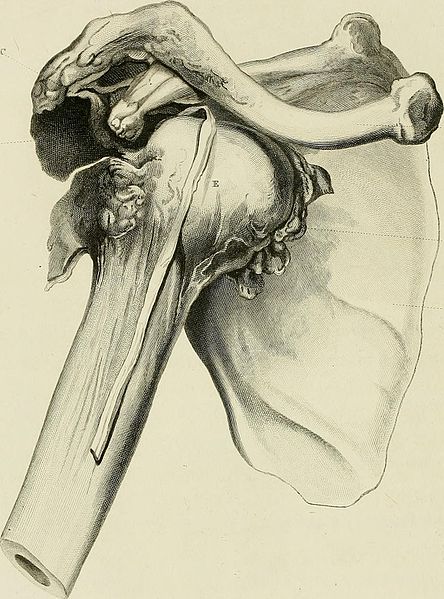 Dislocation of the Humerus from the scapula, glenoid cavity; acromion above it, new socket for the head of the os humeri, fra