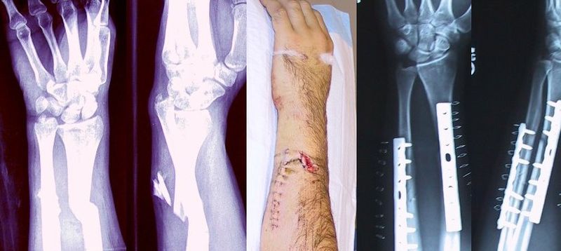 X-ray, Open Fracture, Broken Arm