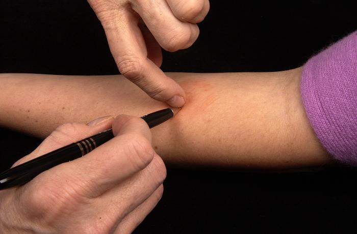 <p>Mantoux Tuberculin Skin Test, Accurate Measurement