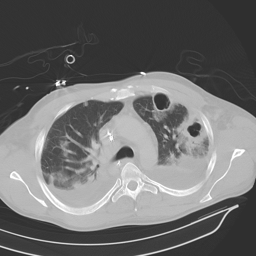 <p>Bilateral Pneumonia, Computed Tomography Scan