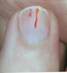 Splinter, Hemorrhage, Nail Anatomy, Finger