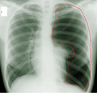 <p>Left Pneumothorax on X-ray