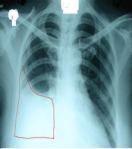 <p>Right Lung Pleural Effusion Radiograph, Posteroanterior