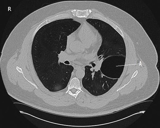 <p>CT Scan, Pneumothorax