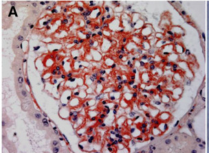 Systemic AL Amyloidosis, Pathology, red-positive glomerular deposits in the mesangium, Capillary walls, Bowman's Capsule, Kid