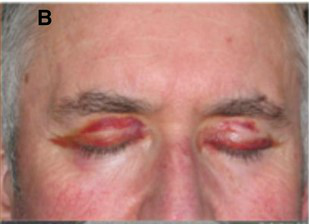 Systemic AL Amyloidosis, Pathology, Bilateral Periorbital purpura, Eyelids