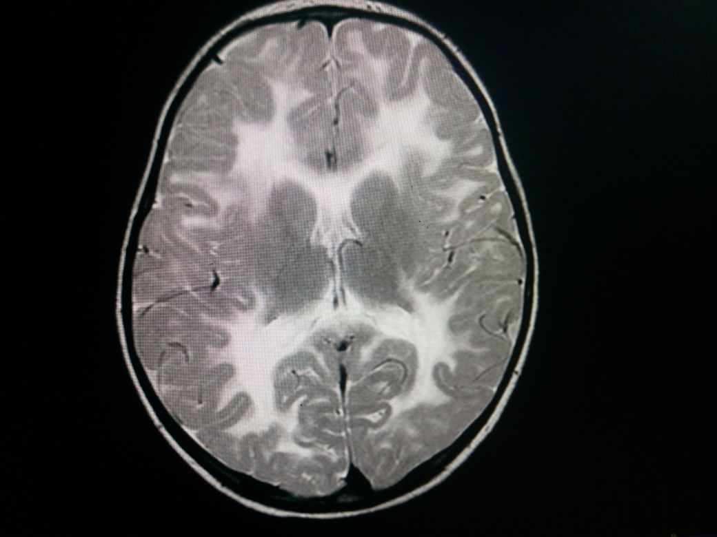 T2W axial slice of brain at level of basal ganglia depicts diffusely  hyperintense signals in white matter extending to the s
