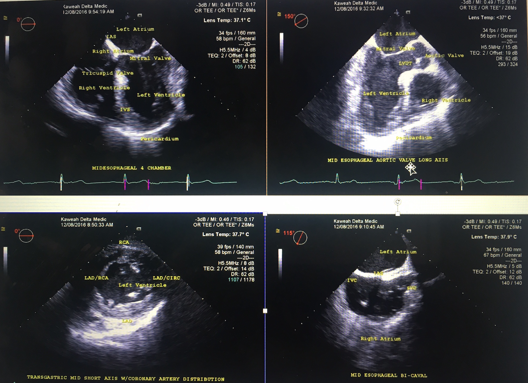 4 basic views to use in the patient who presents in cardiac arrest Image, Image 1; Midesophageal Four-Chamber view (MEFC), Im