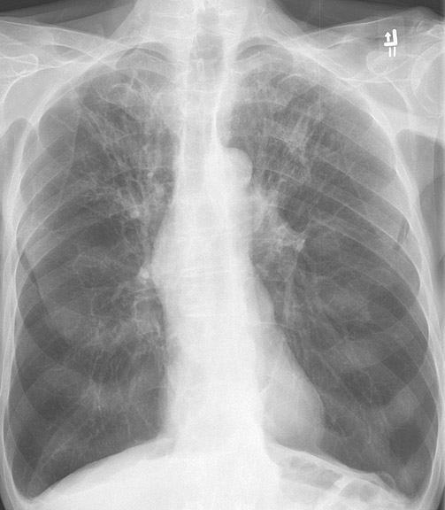 X-ray, Chest, Chronic Obstructive Pulmonary Disease, COPD, Anterior