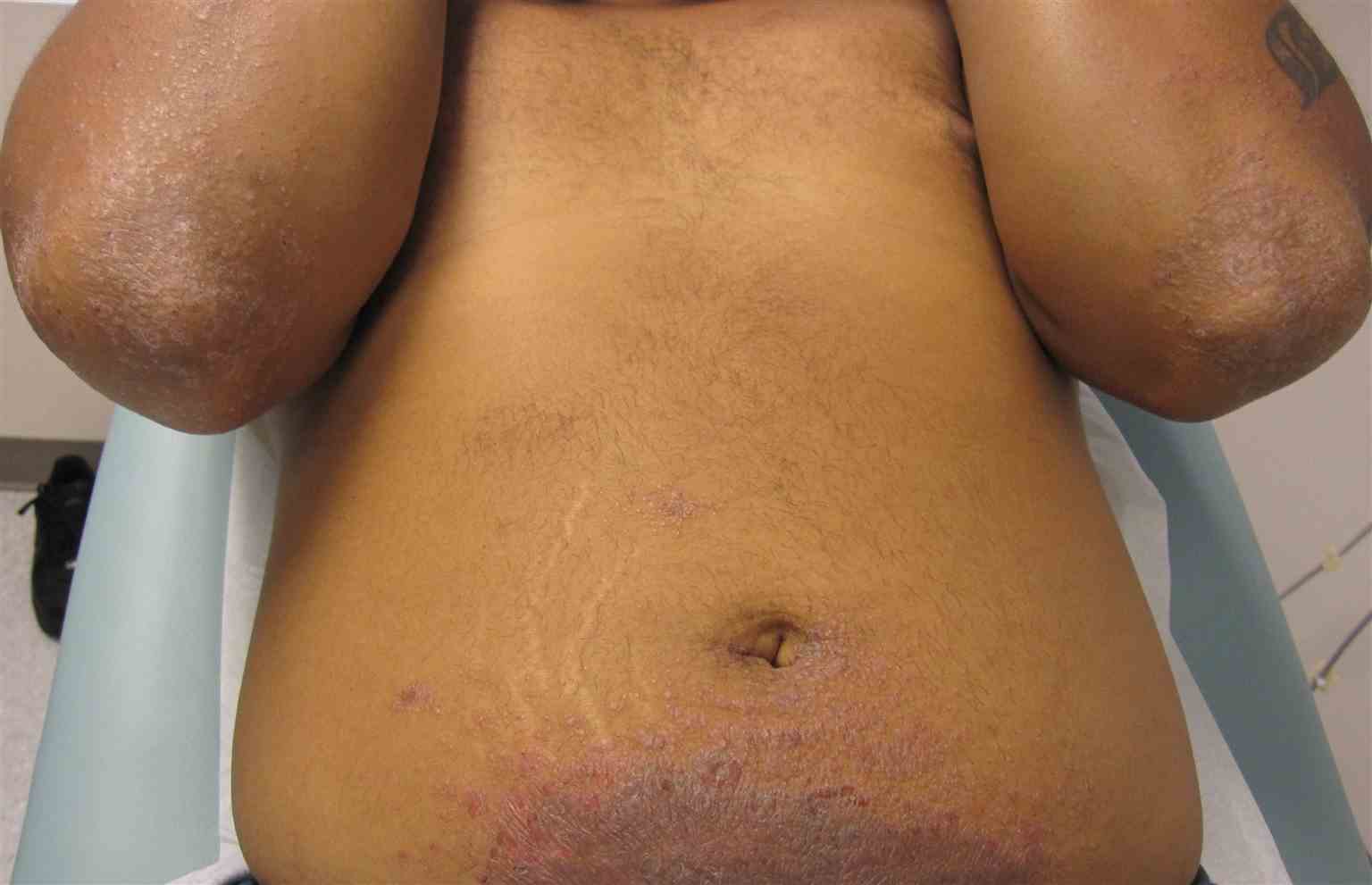 <p>Classic presentation of nickel contact dermatitis involving lower abdomen and id reaction on elbows</p>