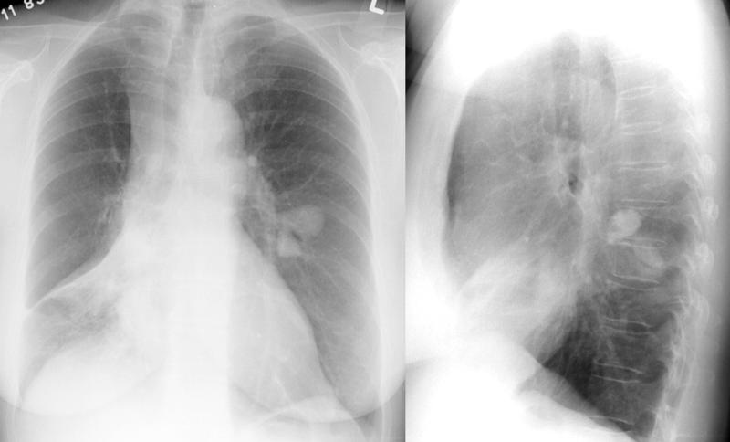 <p>A Chest Radiograph Depicting Asthma