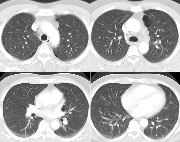 <p>CT Scan COPD,&nbsp;Paraseptal Emphysema</p>