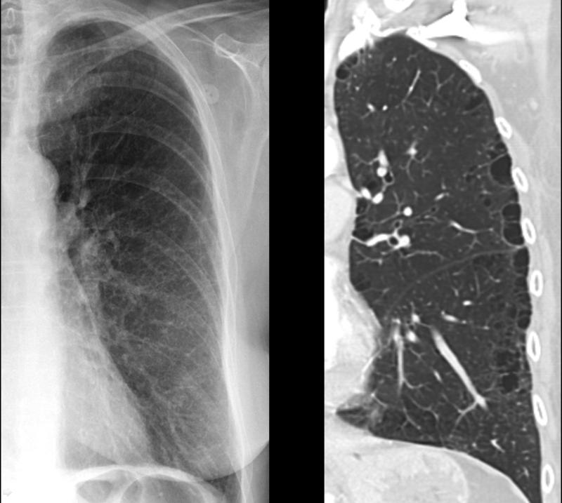 <p>X-ray, COPD, Subtle Paraseptal Emphysema</p>