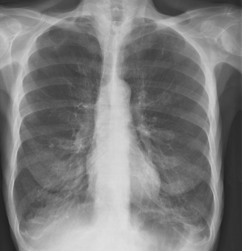 X-ray, COPD, Chronic Obstructive Pulmonary Disease, Emphysema
