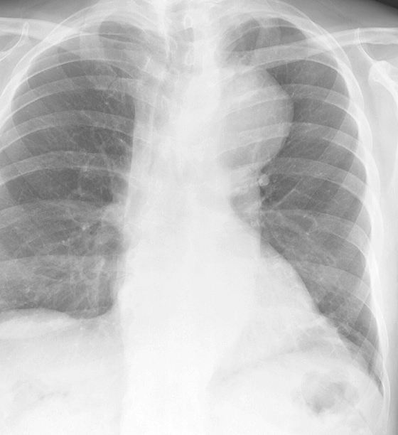 X-ray, Aortic Aneurysm, Cardiac