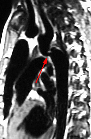 MRI, Cardiac, Coarctation of the Aorta