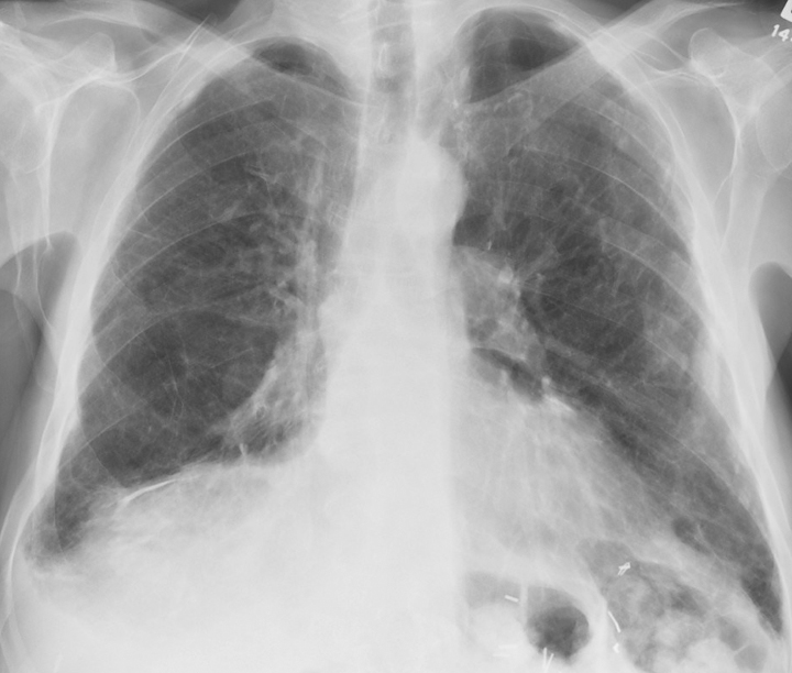 <p>X-ray, Lungs, Asbestos, Anterior View</p>