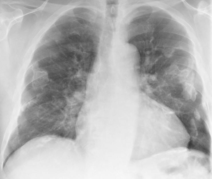<p>X-ray, Anterior View, Lungs, Asbestos</p>
