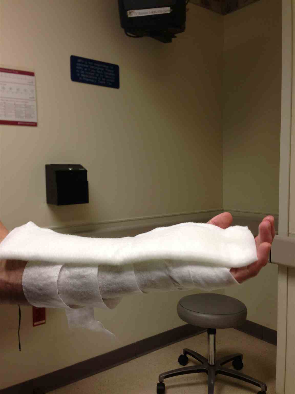 <p>Side View With Padding and Splint Before Elastic Bandage</p>