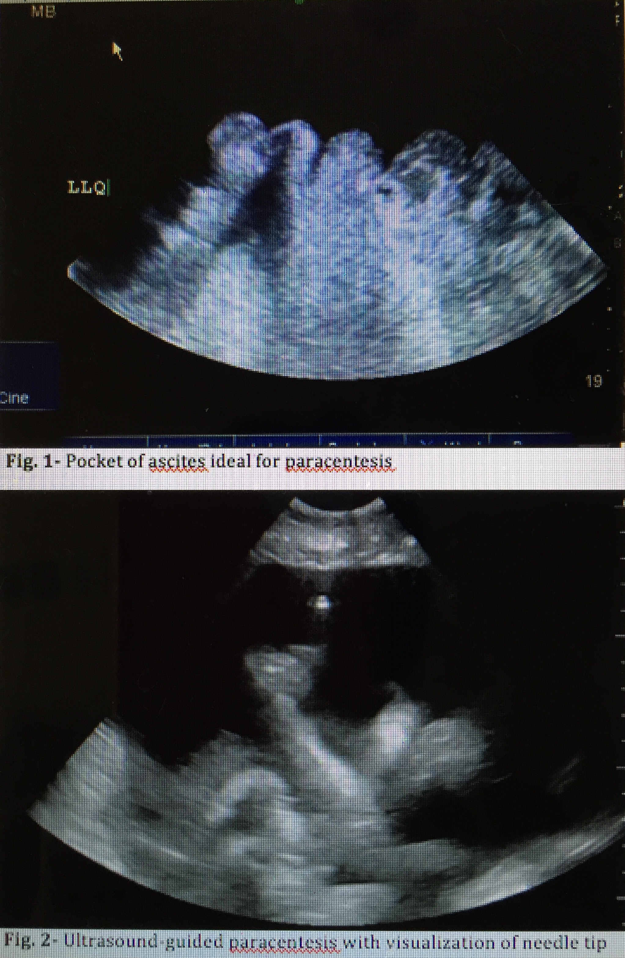 <p>Ultrasound for Paracentesis Uses</p>
