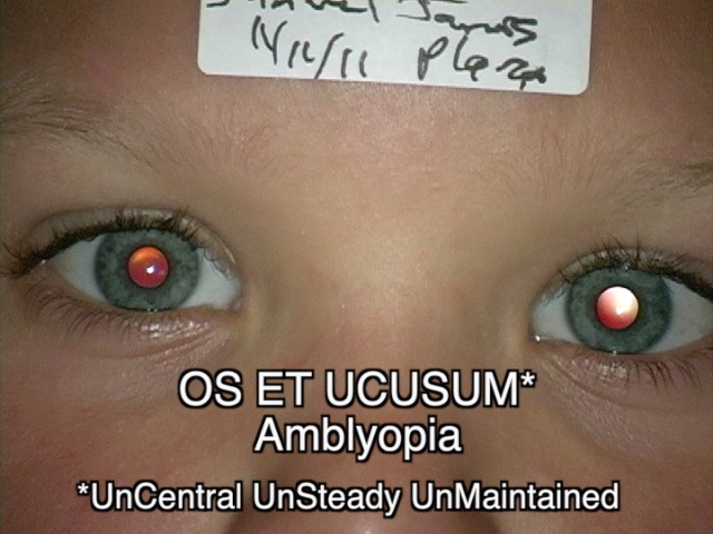 <p>Amblyopia. This image of a pediatric patient demonstrates amblyopia associated with left esotropia.</p>