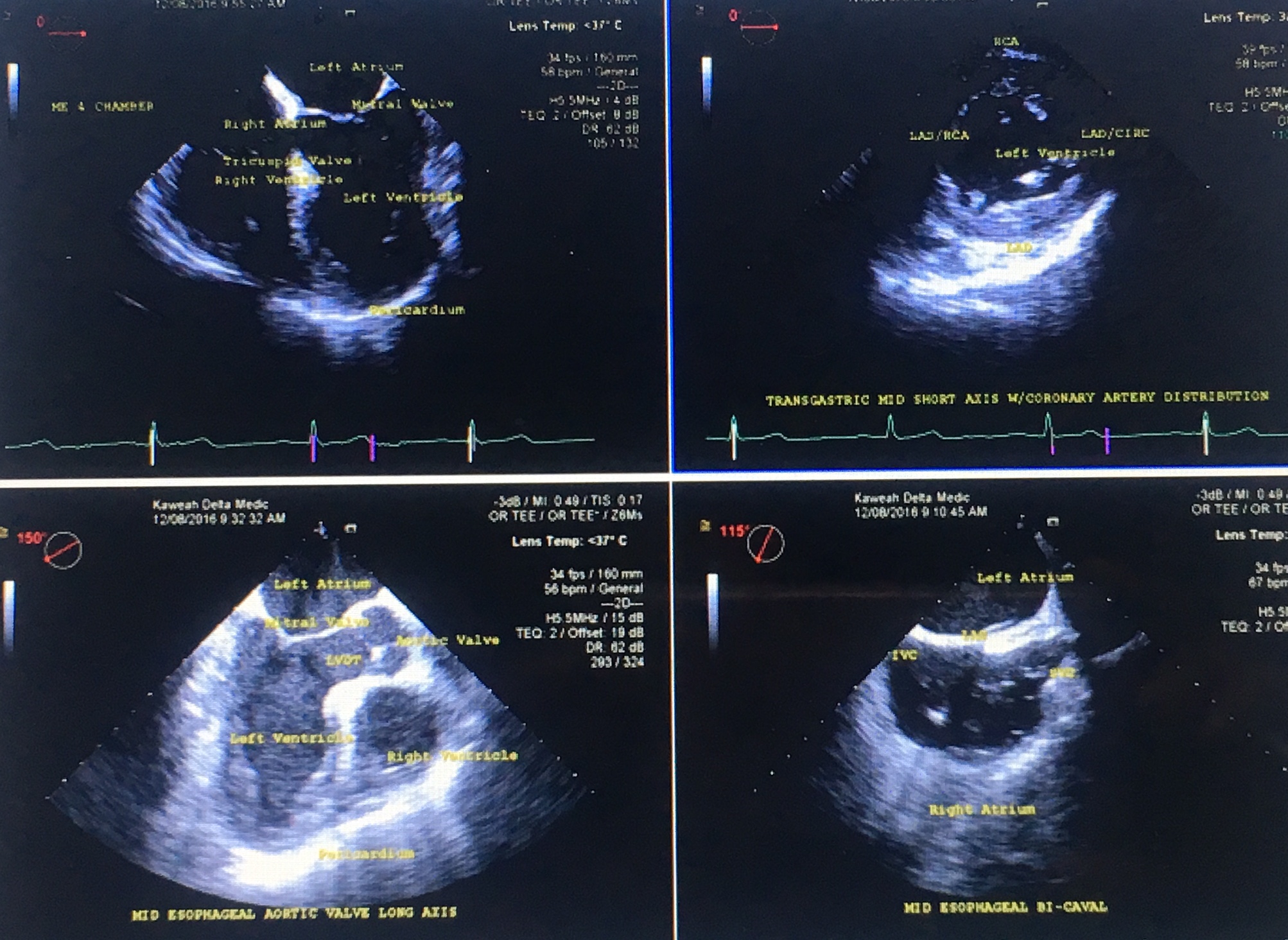 Four View TEE, Transesophageal echocardiography