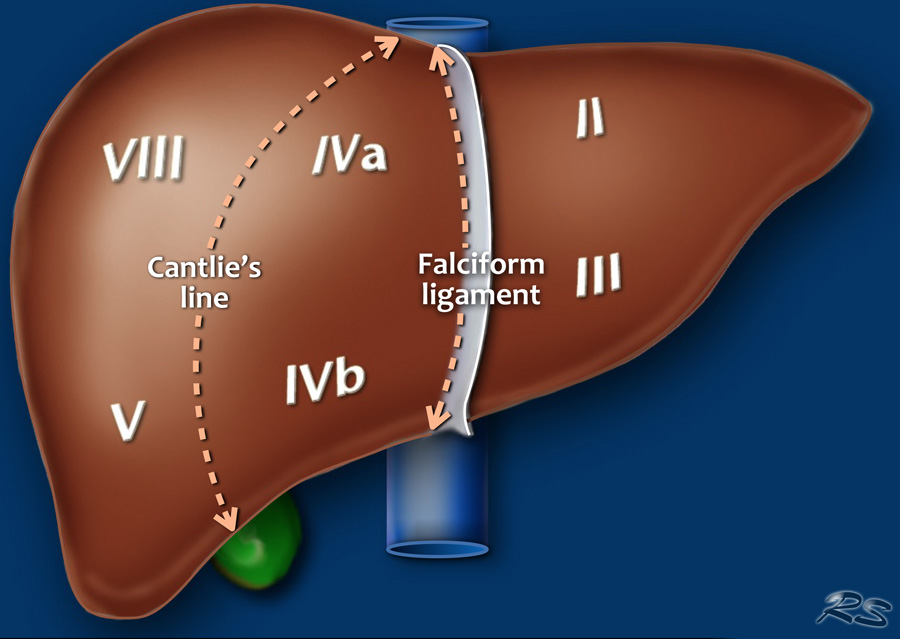 Couinaud system, Frontal view of the liver, the posteriorly located segments VI and VII are not visible, Cantlie's line, Falc