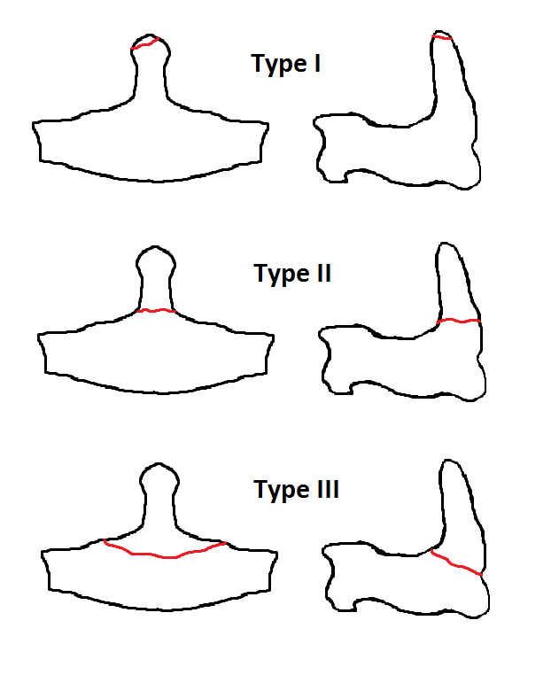 <p>Odontoid Fracture Classification